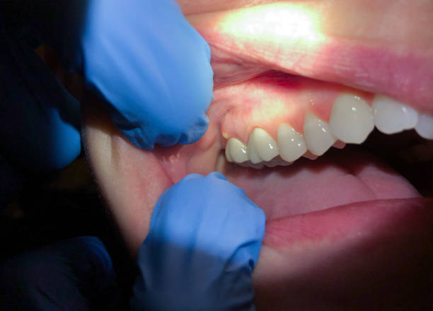 Best Emergency Dentist for Knocked-Out Tooth in Ames, IA